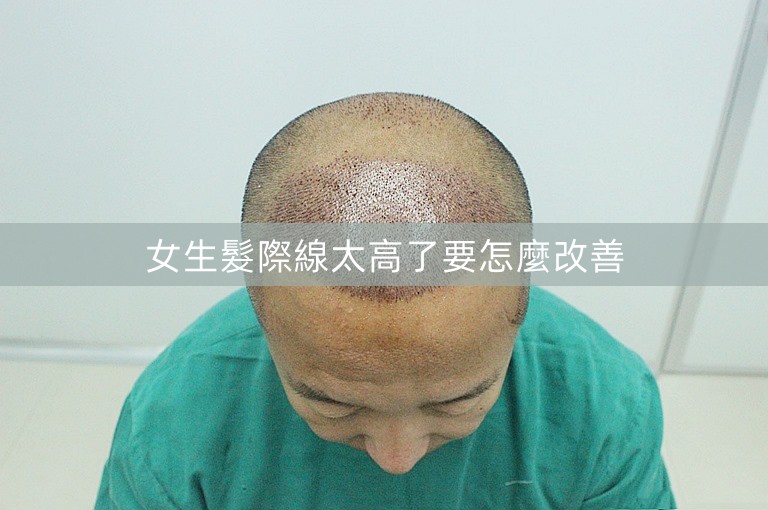女生髮際線太高了要怎麼改善