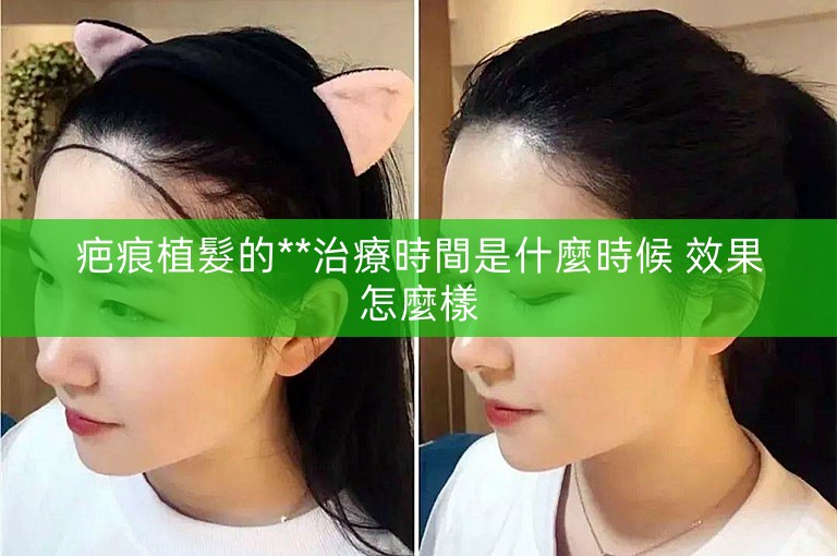 疤痕植髮的**治療時間是什麼時候 效果怎麼樣