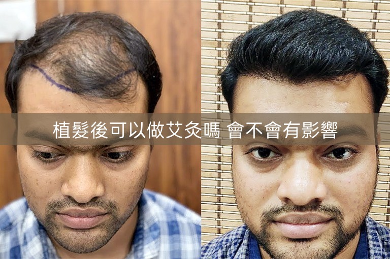 植髮後可以做艾灸嗎 會不會有影響