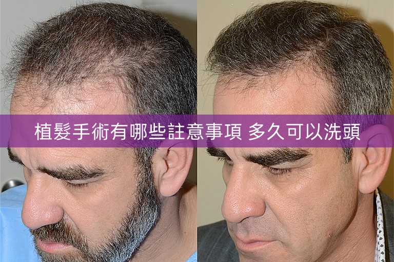 植髮手術有哪些註意事項 多久可以洗頭