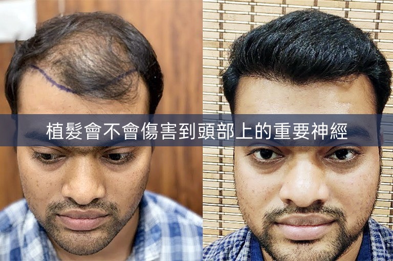 植髮會不會傷害到頭部上的重要神經