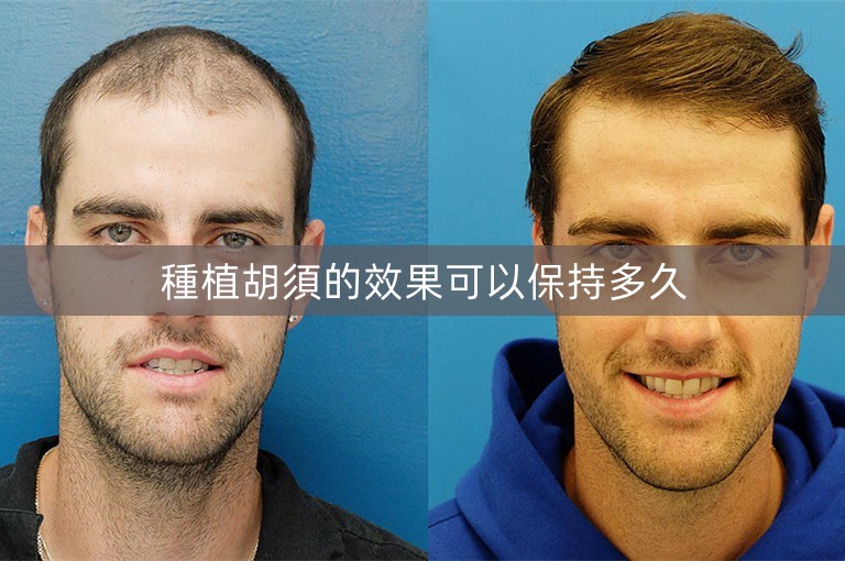 種植胡須的效果可以保持多久