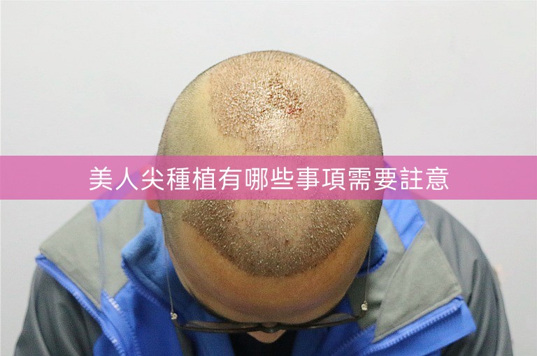 美人尖種植有哪些事項需要註意