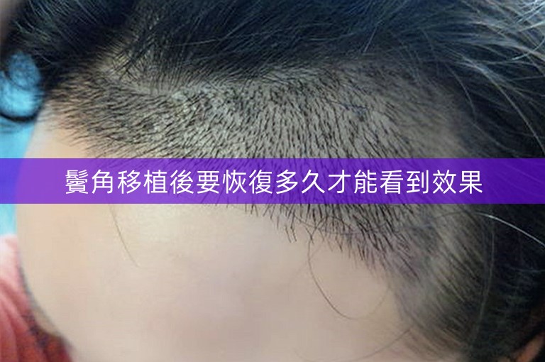 鬢角移植後要恢復多久才能看到效果