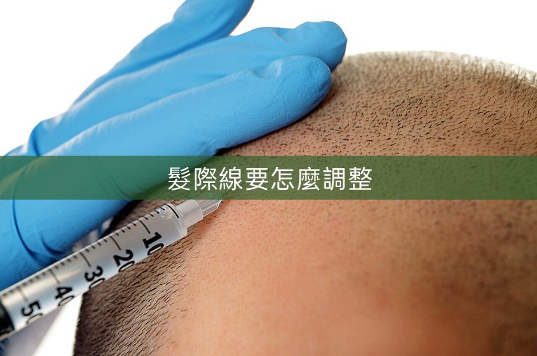 髮際線要怎麼調整