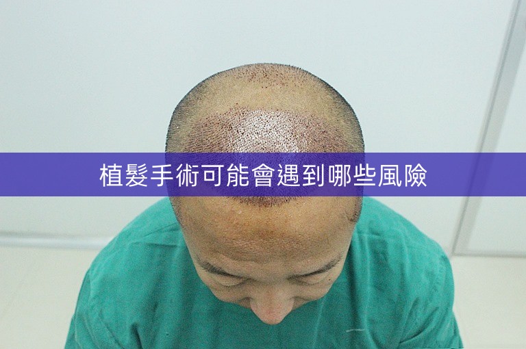 植髮手術可能會遇到哪些風險