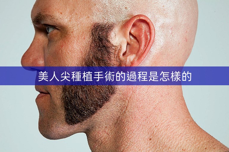 美人尖種植手術的過程是怎樣的
