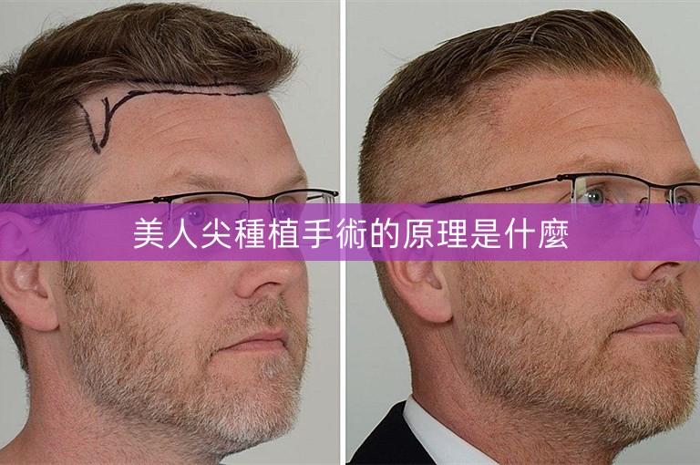 美人尖種植手術的原理是什麼