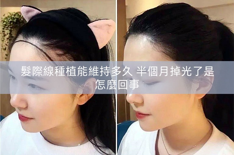 髮際線種植能維持多久 半個月掉光了是怎麼回事