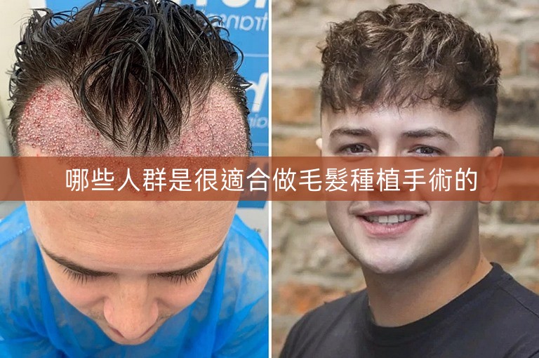 哪些人群是很適合做毛髮種植手術的