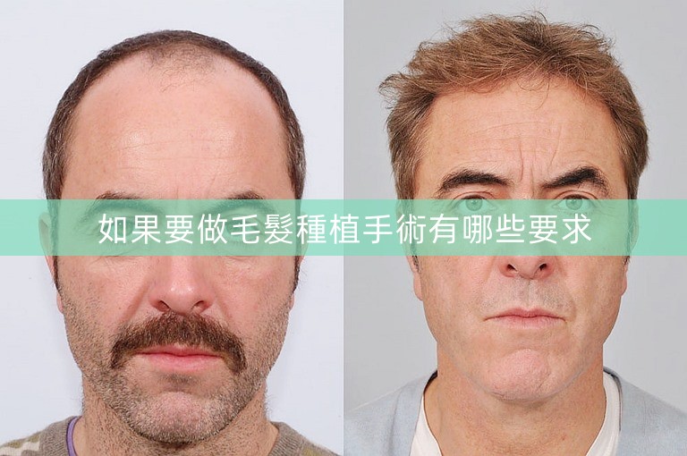 如果要做毛髮種植手術有哪些要求