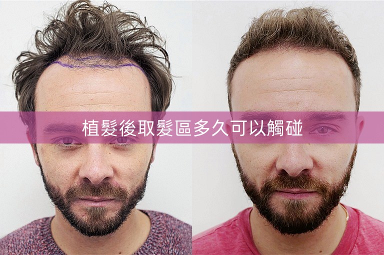 植髮後取髮區多久可以觸碰
