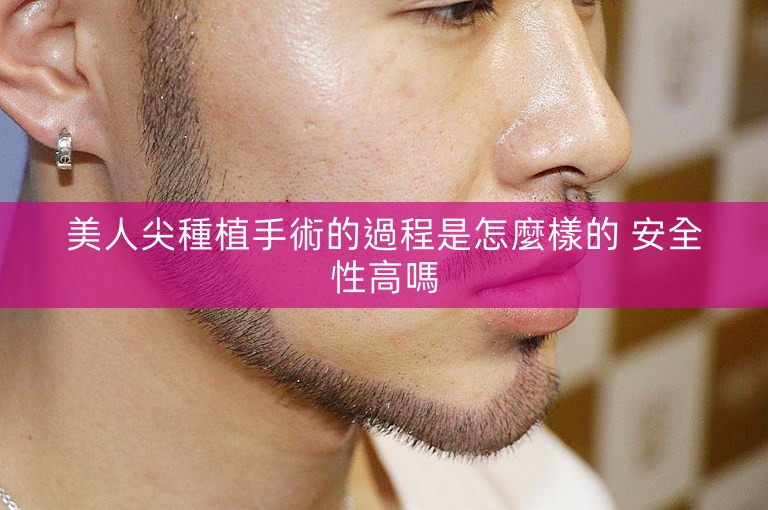 美人尖種植手術的過程是怎麼樣的 安全性高嗎