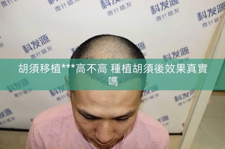 胡須移植***高不高 種植胡須後效果真實嗎 胡須移植***高不高 種植胡須後效果真實嗎