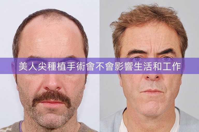 美人尖種植手術會不會影響生活和工作