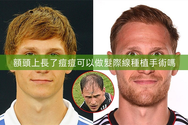 額頭上長了痘痘可以做髮際線種植手術嗎 額頭上長了痘痘可以做髮際線種植手術嗎