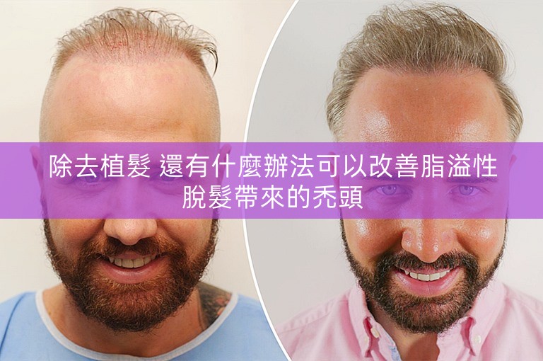 除去植髮 還有什麼辦法可以改善脂溢性脫髮帶來的禿頭