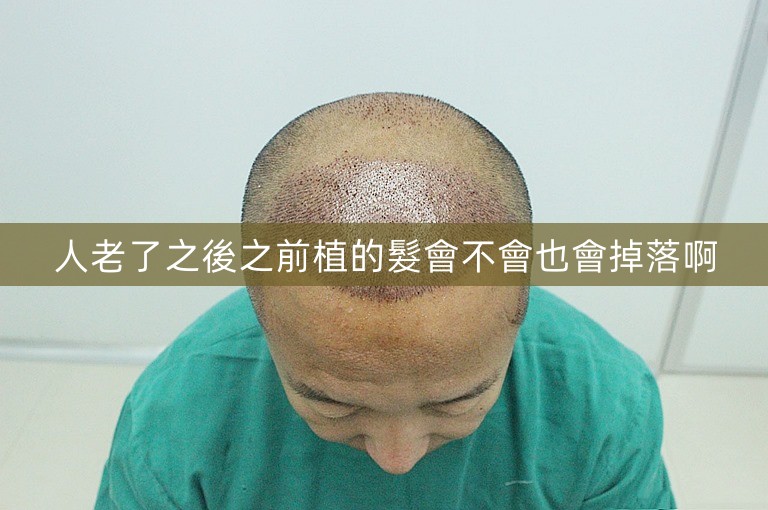 人老了之後之前植的髮會不會也會掉落啊
