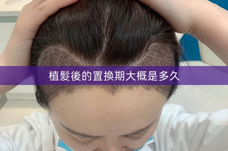 植髮後的置換期大概是多久