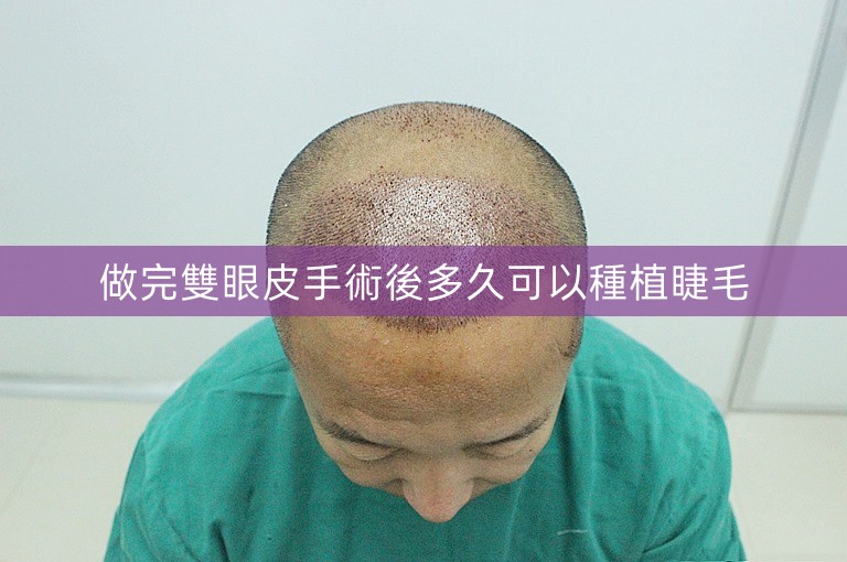 做完雙眼皮手術後多久可以種植睫毛