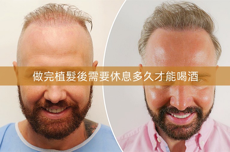 做完植髮後需要休息多久才能喝酒