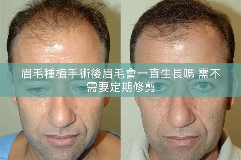 眉毛種植手術後眉毛會一直生長嗎 需不需要定期修剪