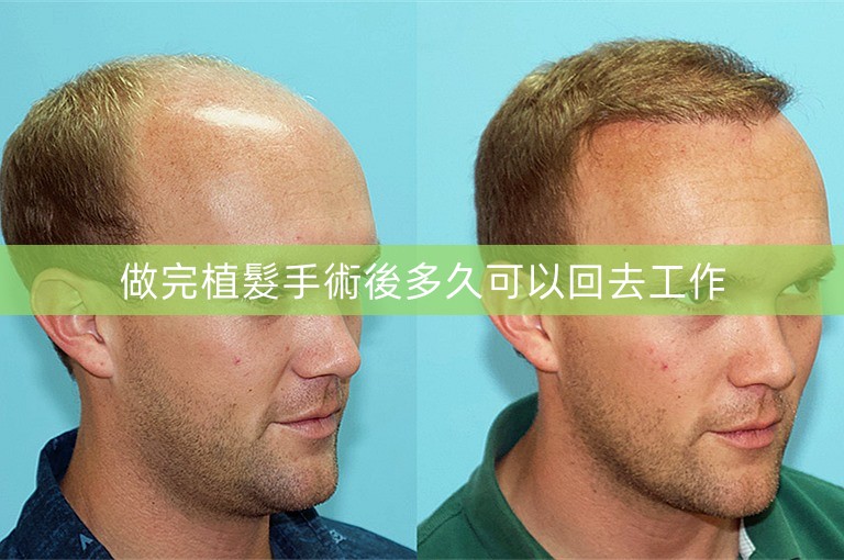做完植髮手術後多久可以回去工作