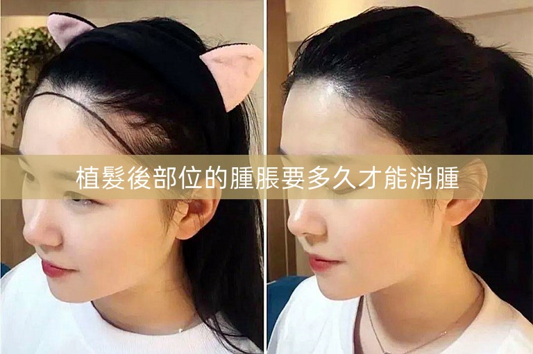 植髮後部位的腫脹要多久才能消腫