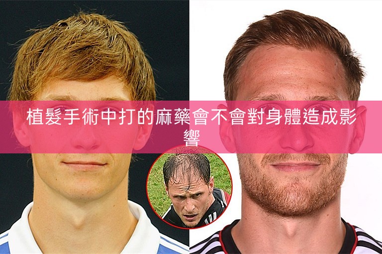 植髮手術中打的麻藥會不會對身體造成影響 植髮手術中打的麻藥會不會對身體造成影響