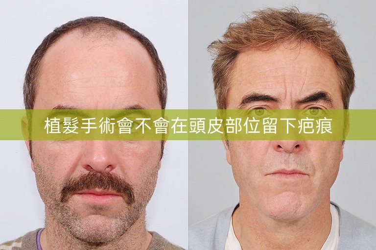 植髮手術會不會在頭皮部位留下疤痕