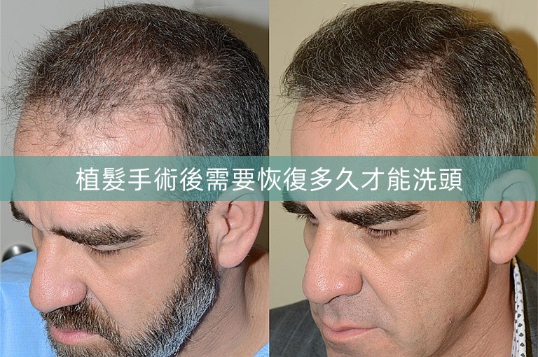 植髮手術後需要恢復多久才能洗頭