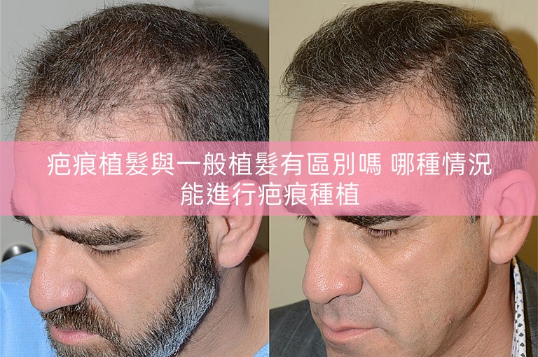 疤痕植髮與一般植髮有區別嗎 哪種情況能進行疤痕種植