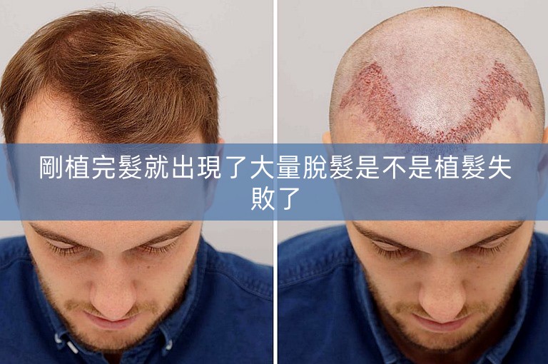 剛植完髮就出現了大量脫髮是不是植髮失敗了