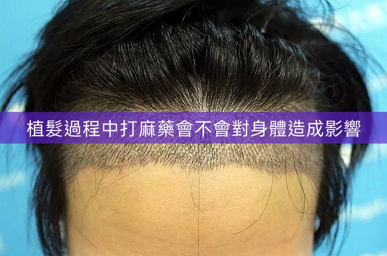 植髮過程中打麻藥會不會對身體造成影響