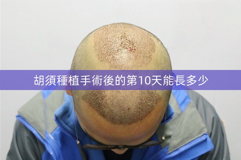 胡須種植手術後的第10天能長多少