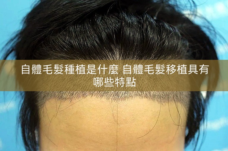 自體毛髮種植是什麼 自體毛髮移植具有哪些特點 自體毛髮種植是什麼 自體毛髮移植具有哪些特點