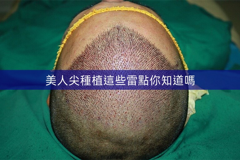 美人尖種植這些雷點你知道嗎