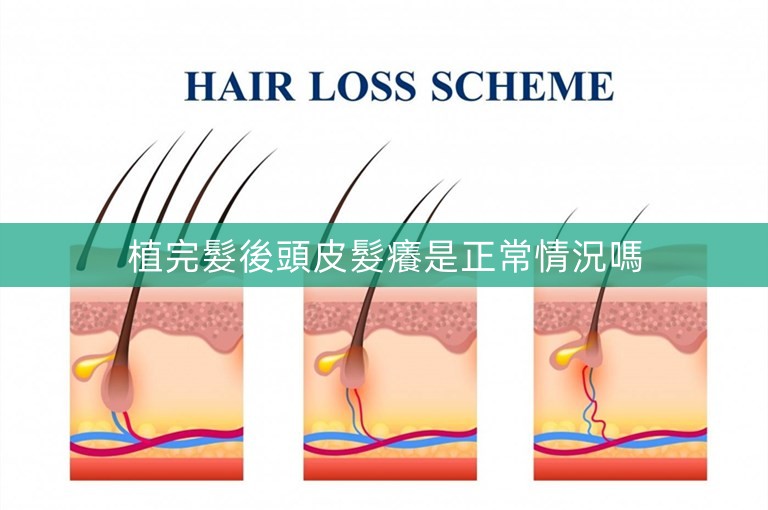 植完髮後頭皮髮癢是正常情況嗎