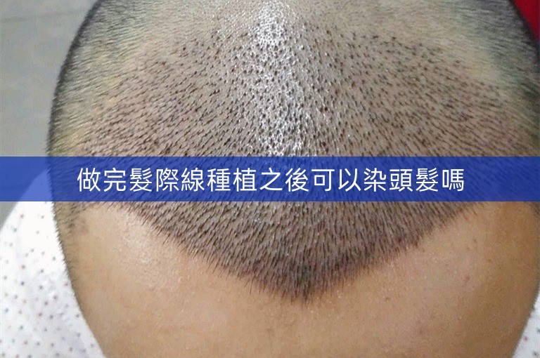 做完髮際線種植之後可以染頭髮嗎