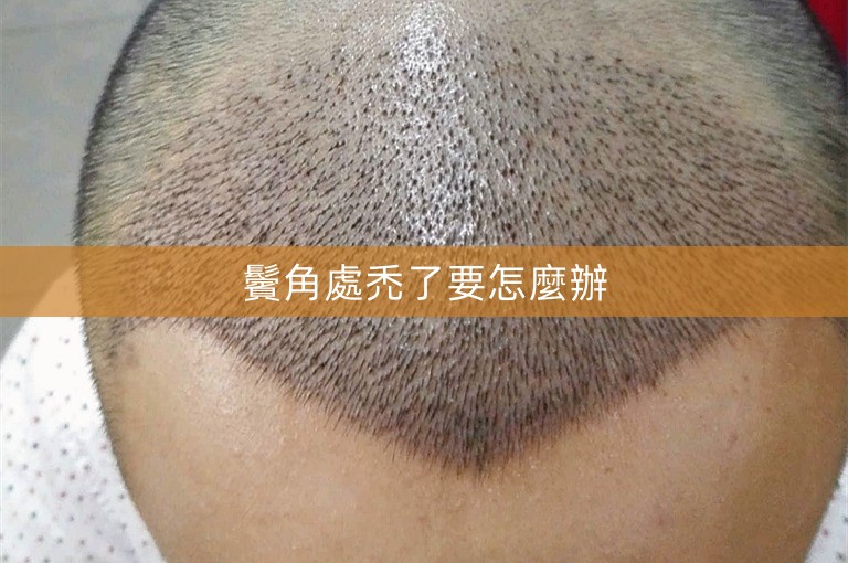 鬢角處禿了要怎麼辦