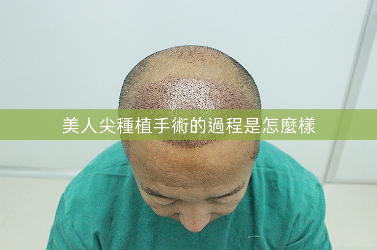 美人尖種植手術的過程是怎麼樣