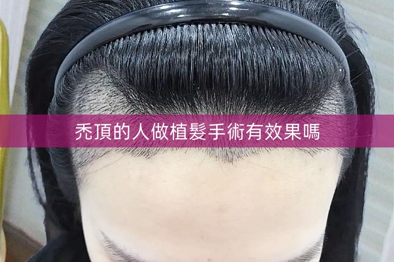 禿頂的人做植髮手術有效果嗎