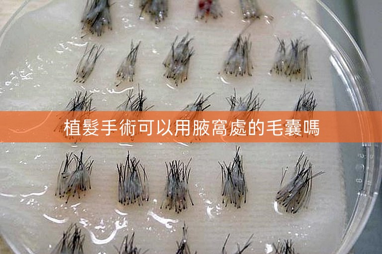 植髮手術可以用腋窩處的毛囊嗎