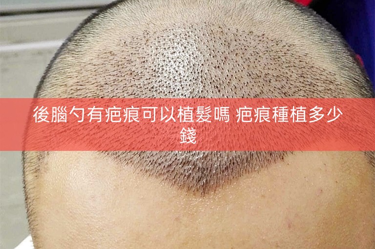 後腦勺有疤痕可以植髮嗎 疤痕種植多少錢