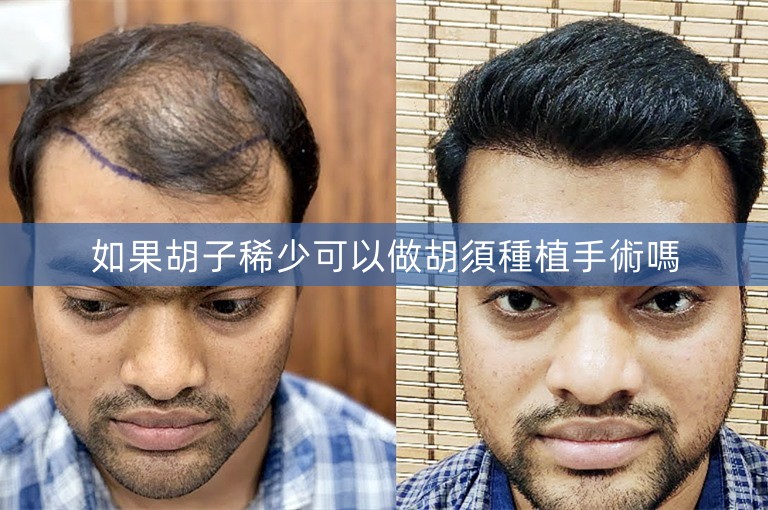 如果胡子稀少可以做胡須種植手術嗎
