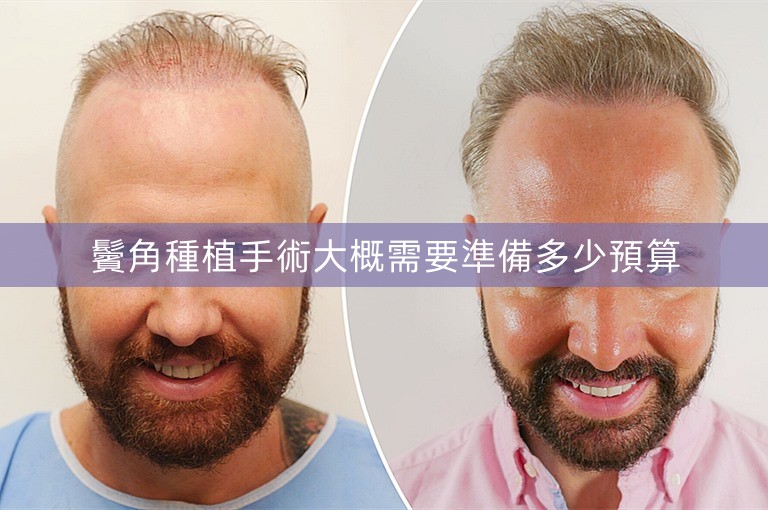 鬢角種植手術大概需要準備多少預算 鬢角種植手術大概需要準備多少預算