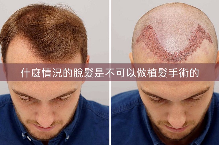 什麼情況的脫髮是不可以做植髮手術的