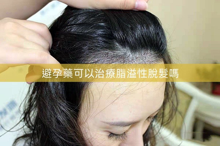 避孕藥可以治療脂溢性脫髮嗎