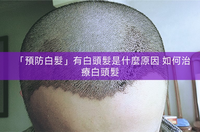 「預防白髮」有白頭髮是什麼原因 如何治療白頭髮 「預防白髮」有白頭髮是什麼原因 如何治療白頭髮