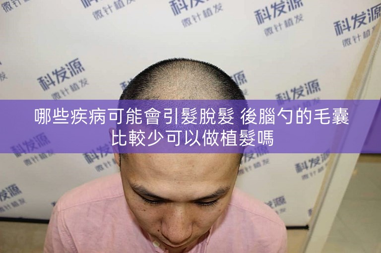 哪些疾病可能會引髮脫髮 後腦勺的毛囊比較少可以做植髮嗎